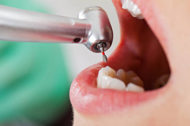 Best Emergency Treatment for Toothache in Egon City, OR